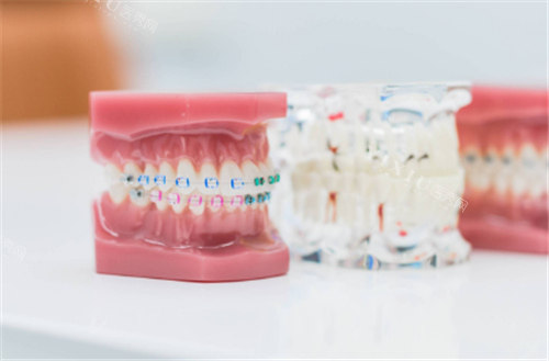 曲靖牙齿矫正大概要花费多少钱？8000-50000元起不等！具体请查询正畸牙套价格表(图3)