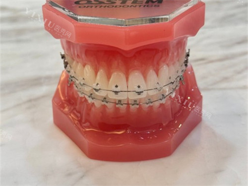 牙齿矫正陶瓷托槽牙套模型图