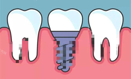 钛锆和瑞锆种植体区别是什么？多方面详细介绍相关资料！(图3)