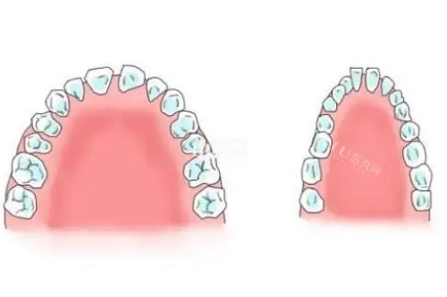 正常牙弓和上牙弓狭窄对比图