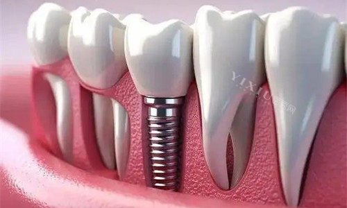 钛锆和瑞锆种植体区别是什么？多方面详细介绍相关资料！(图2)