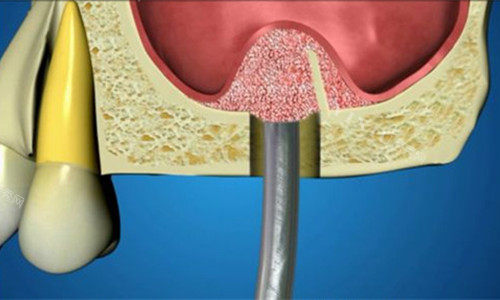 钛锆和瑞锆种植体区别是什么？多方面详细介绍相关资料！(图1)