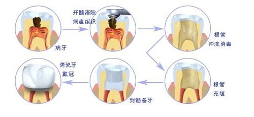 根管治疗过程图