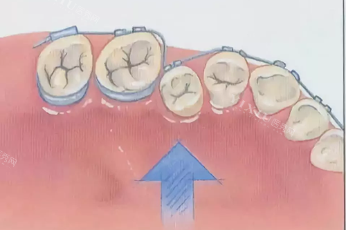 达芬奇隐形牙套多少钱？1.5-3万元左右！不同版本价格揭秘，详细收费更新！(图2)