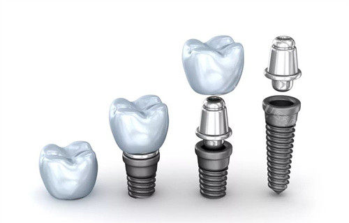 韩国奥齿泰种植牙有几个系列？U系列／SS系列／TS系列／MS系列多方面分析！(图3)