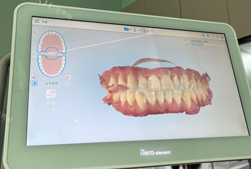 曙美隐形牙套有用过的吗，做正畸改善好不好收费一般在多少？(图1)