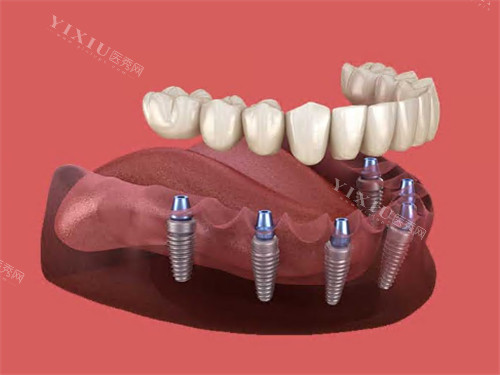​天水种植牙多少钱一颗？帮您找到了天水种植牙品牌及价格解析(图2)