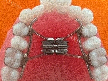 详细分析儿童扩弓矫正牙齿的利弊，儿童牙齿早期扩弓有必要吗？9岁儿童扩弓器一般戴多久？(图2)