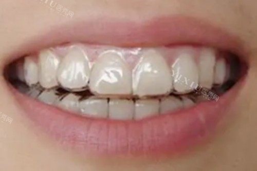 想选隐形牙套但是预算有限推荐美立刻隐形矫正器！有经典／Alpha／大师／π版四个型号！(图3)