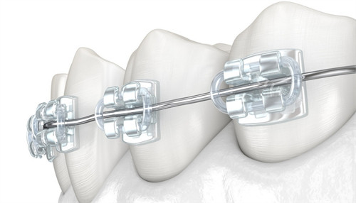 欧晴自锁托槽是国产吗？是！8000元+亲民植体，改善特色优势有这些！(图3)