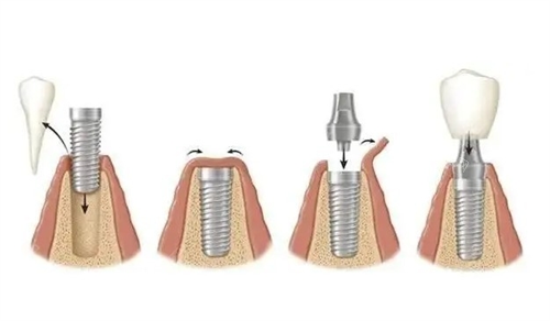 韩国奥齿泰种植牙质量怎么样，详细解析寿命价格以及是否值得选择！(图2)