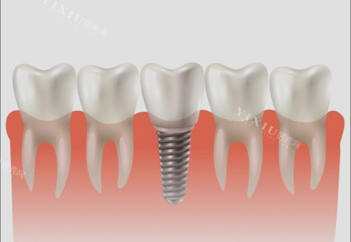 种植牙单颗漫画示意图