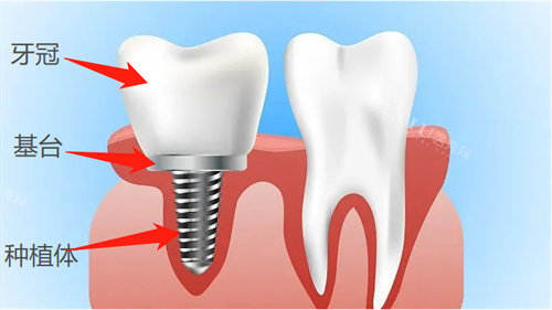 种植牙基台牙冠示意图