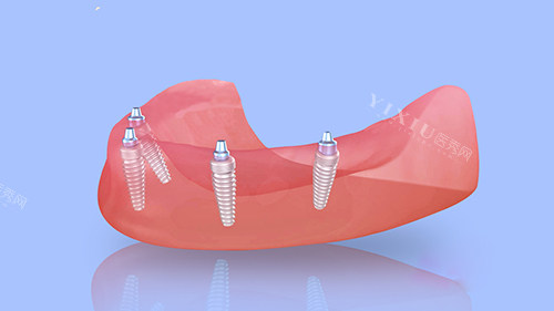半口种植牙四颗植体植入漫画图