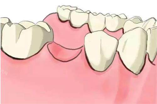 单颗牙缺失