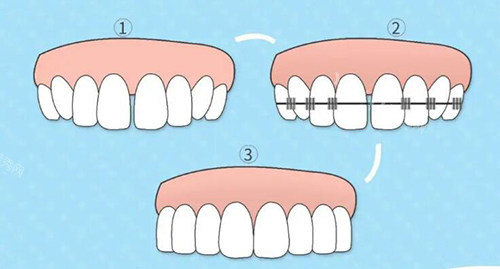 正畸简单示意图展示