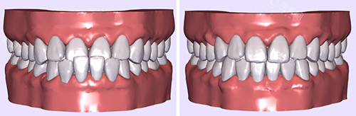 牙齿矫正模拟图前后对比