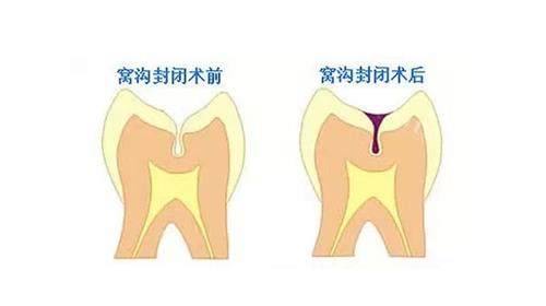 窝沟封闭后的成效