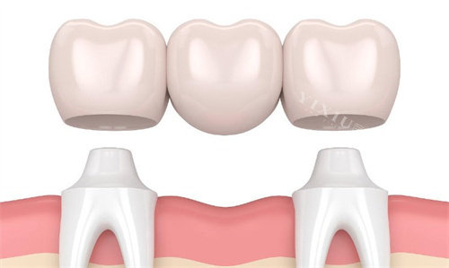 牙冠三联桥示意图