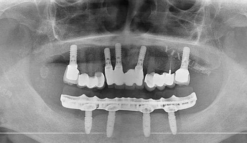 全口种植牙拍片示意图