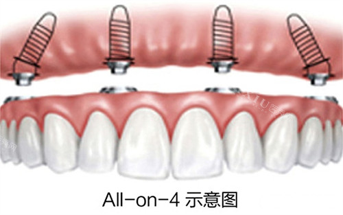 韩国柯威尔亲水种植体采用了11°莫氏锥度及2.5六角内连接的方式！单颗价格6500元+半口40000+！(图1)