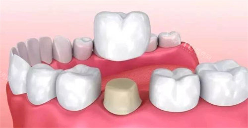 拆下来的烤瓷牙还能用吗？烤瓷牙做核磁都不行吗？(图2)