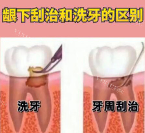 龈下刮治和洗牙对比