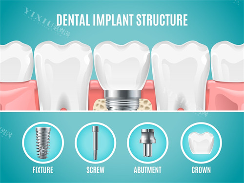 种植牙植体组成部分展示
