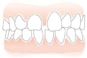 正畸后牙缝示意图
