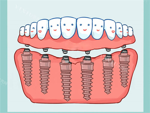 All-On-6全口种植牙漫画图