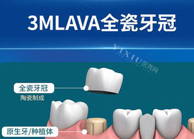 3M拉瓦全瓷牙冠修复