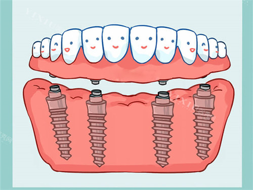 All-On-4全口种植牙漫画图