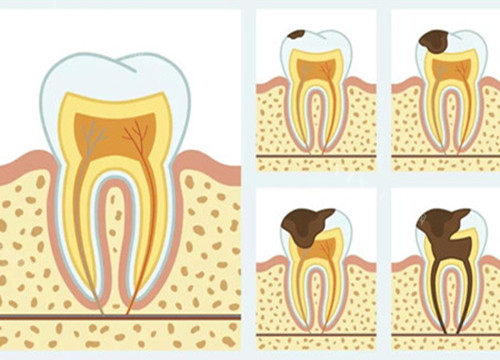 牙齿龋坏不同程度图片