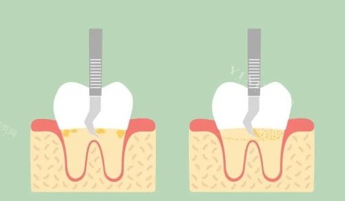 龈下刮治后的成效