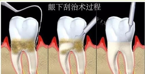 龈下刮治手术过程