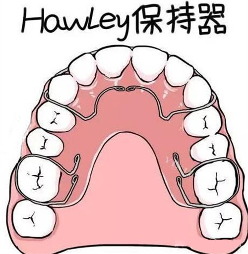 牙齿矫正Hawley哈雷保持器