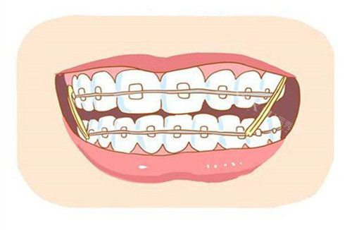 牙齿矫正卡通图
