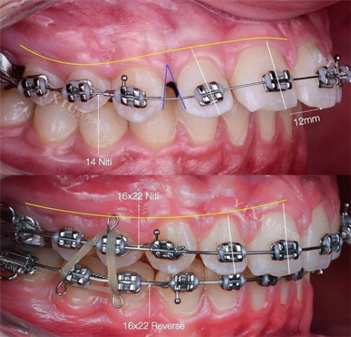金属托槽矫正正畸图