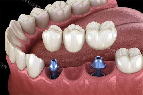 济南吴高义种植牙怎么样？来听听网友怎么说，种植牙口碑、技术、价格、成效全解析！(图2)