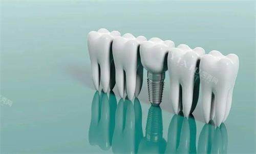 韩国sg种植体属于什么档次？质量到底怎么样？牙医说出实话！(图1)