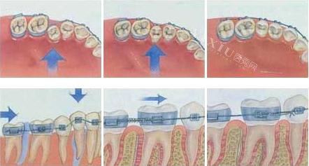 牙齿矫正移动过程示意图