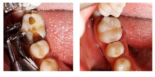 树脂补牙前后