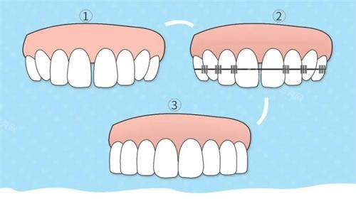 牙齿矫正的步骤