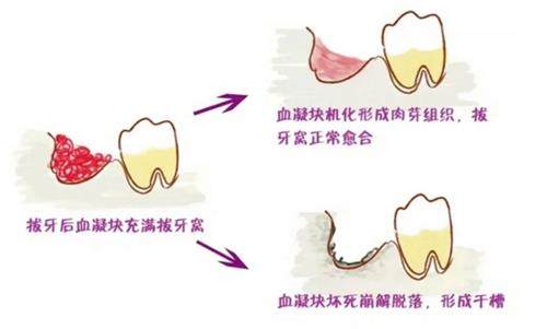 干槽症的形成原因