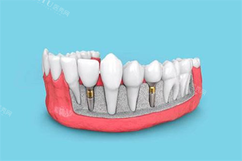 韩国多普勒植体是低端产品吗？真不是！从材质／价格／使用时间等方面详细介绍！(图2)