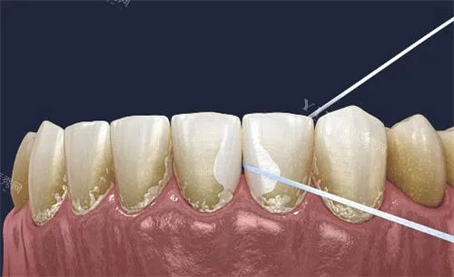 牙线清理牙齿缝隙