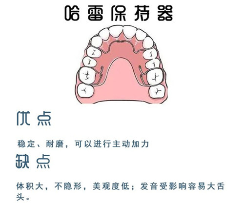 牙齿矫正哈雷保持器