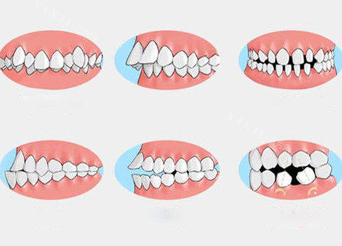 需要牙齿矫正的问题