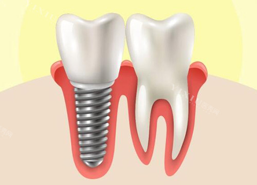 牙齿种植对比真牙图