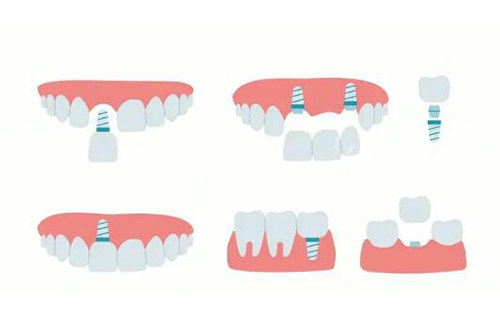 种植牙改善卡通图照片